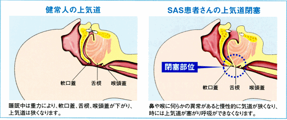 閉塞性睡眠時無呼吸症候群の合併症の可能性